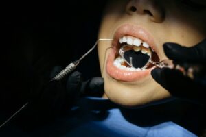 Composite Dental Crowns for Children