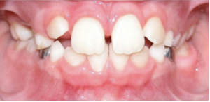 Howard County kids dental experts